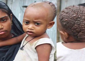 মাথায় বিরল রোগ আক্রান্ত কুড়িগ্রামের সিফাত, সহযোগিতার আবেদন পরিবারের