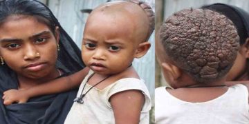 মাথায় বিরল রোগ আক্রান্ত কুড়িগ্রামের সিফাত, সহযোগিতার আবেদন পরিবারের