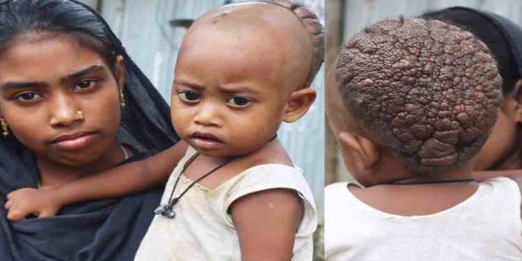 মাথায় বিরল রোগ আক্রান্ত কুড়িগ্রামের সিফাত, সহযোগিতার আবেদন পরিবারের