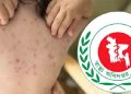 হাম ও উপসর্গে আরও ৯ শিশুর মৃত্যু