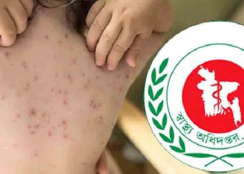 হাম ও উপসর্গে আরও ৯ শিশুর মৃত্যু