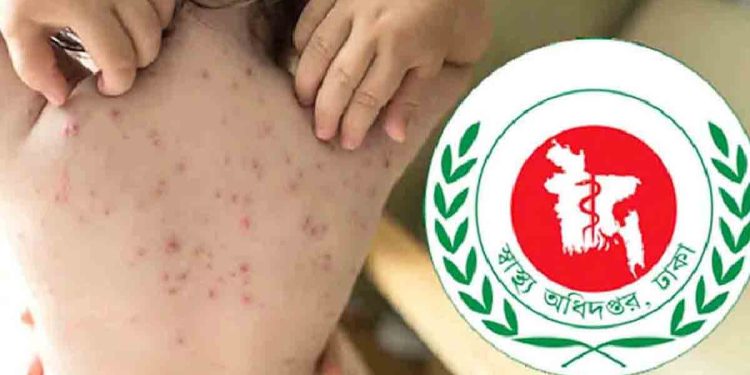 হাম ও উপসর্গে আরও ৯ শিশুর মৃত্যু