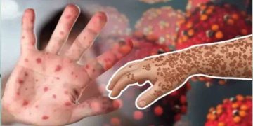 হাম ও উপসর্গ নিয়ে ১০ শিশুর মৃত্যু